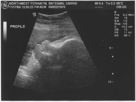 ultrasound dating accuracy 13 weeks